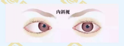 什么是調(diào)節(jié)性內(nèi)斜視？