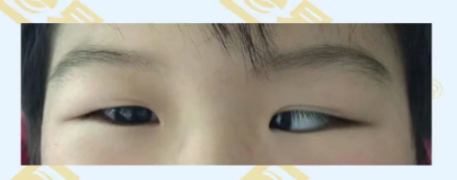 什么是先天性內(nèi)斜視？