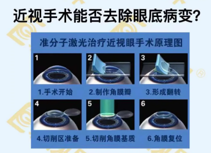 近視手術(shù)能否去除眼底病變？