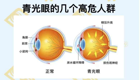 青光眼的幾個高危人群？