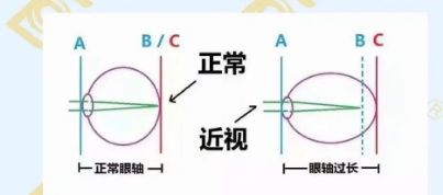 哪個(gè)年齡近視度數(shù)最容易增長？