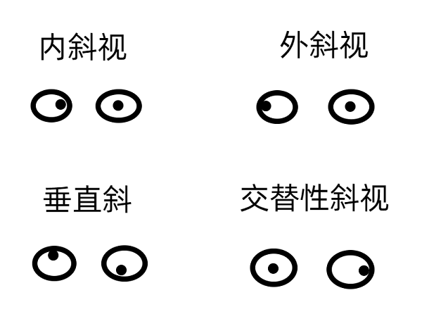 斜視早期的癥狀有哪些？